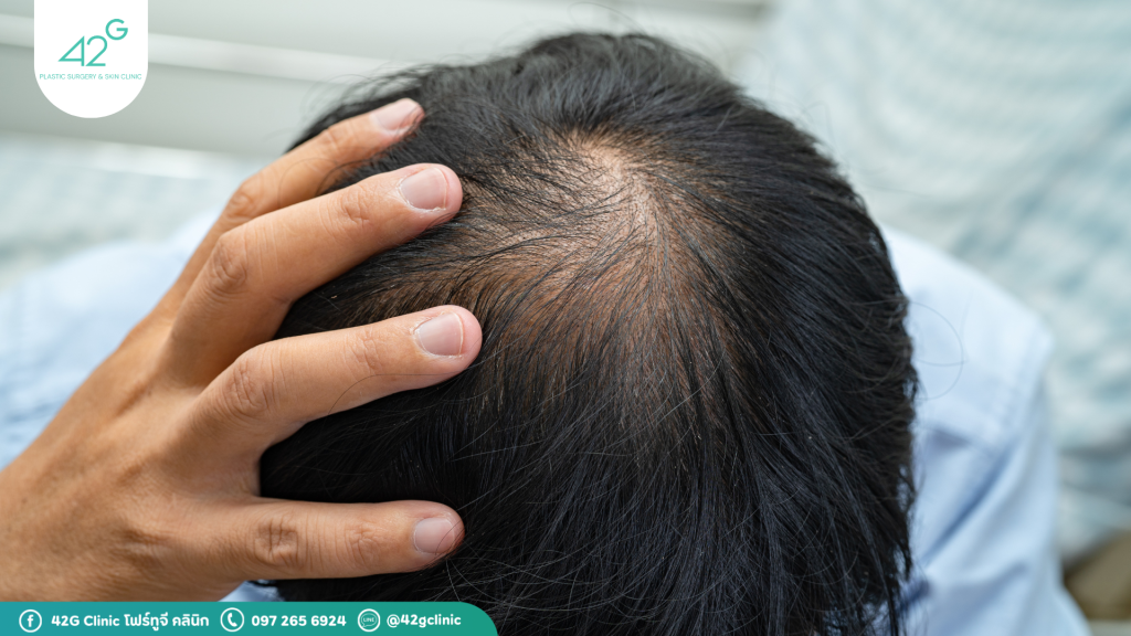 Early-stage hair loss is treatable — but once the follicles are gone, they’re gone for good. Reclaim your confidence with our trusted, natural-looking hair transplant solution.