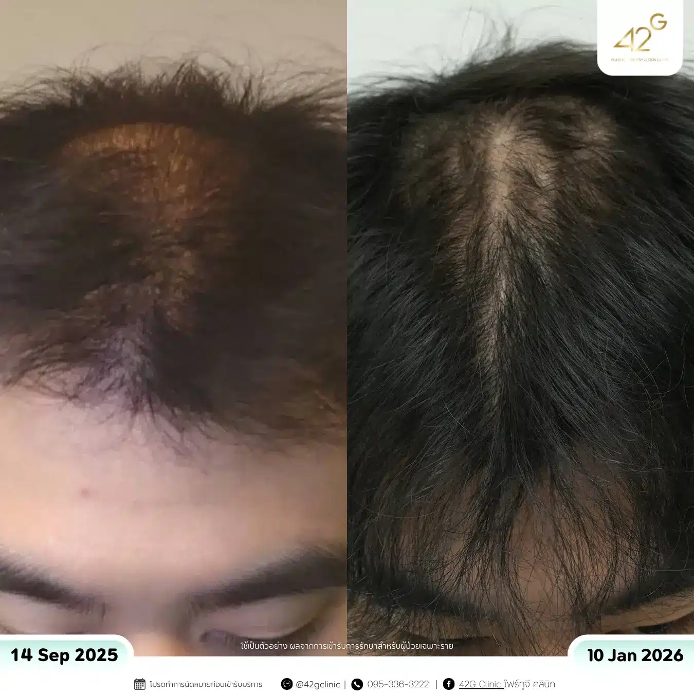 รีวิวPRP (1)