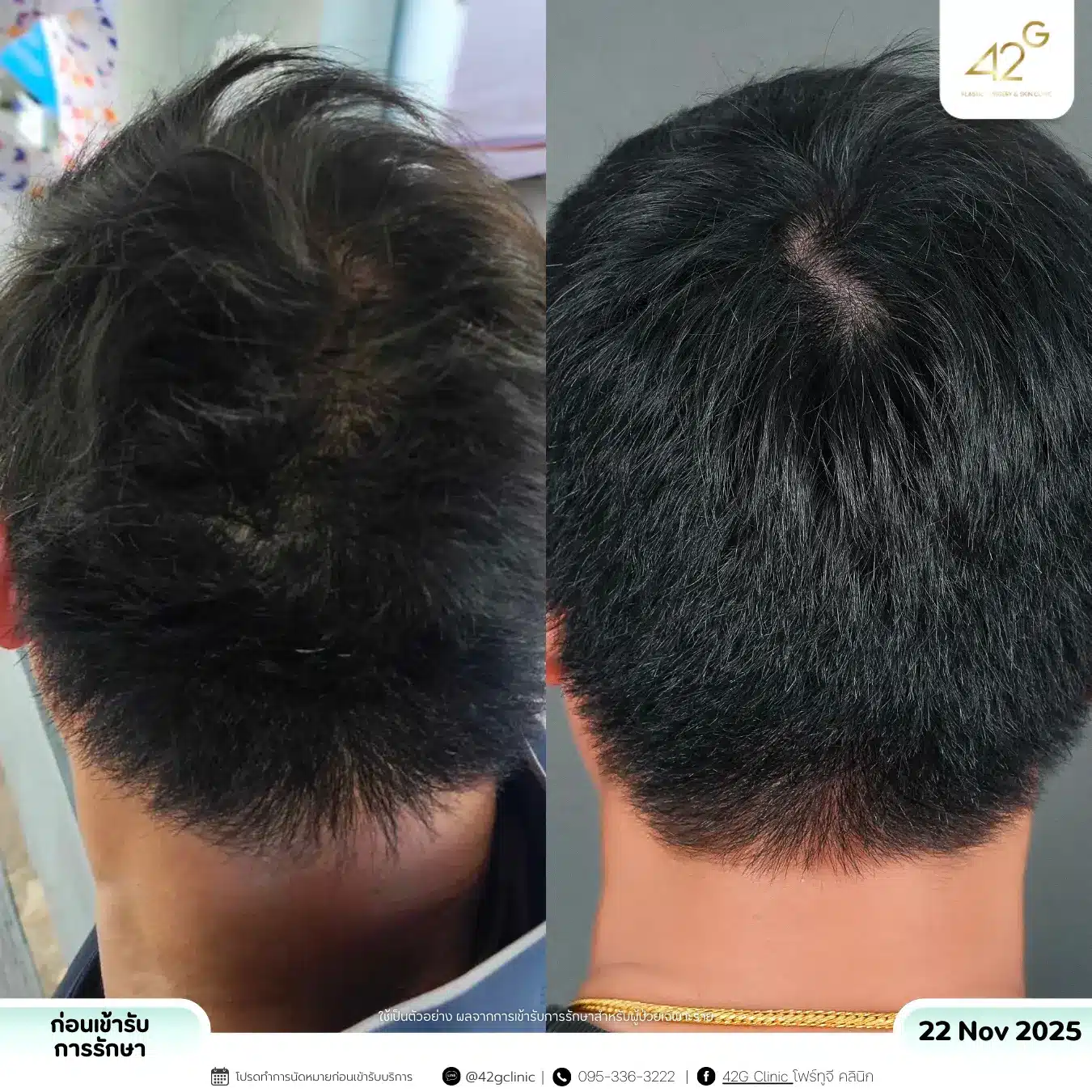 รีวิวPRP (2)