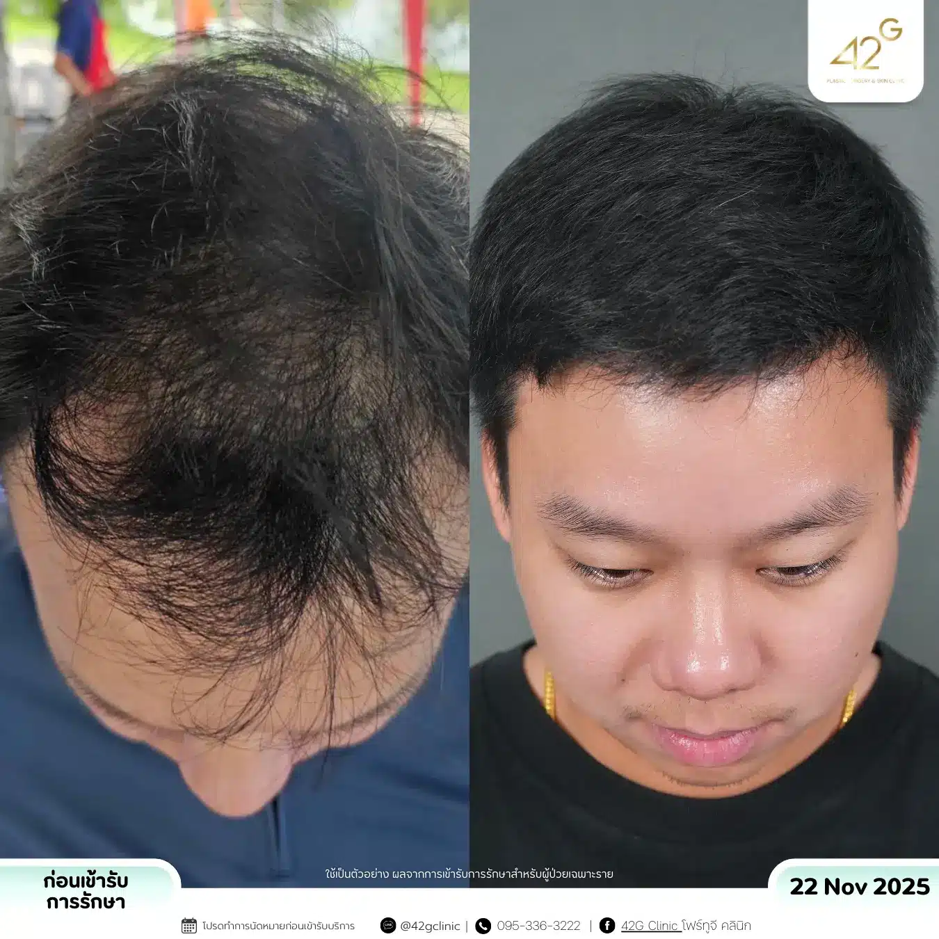 รีวิวPRP (3)