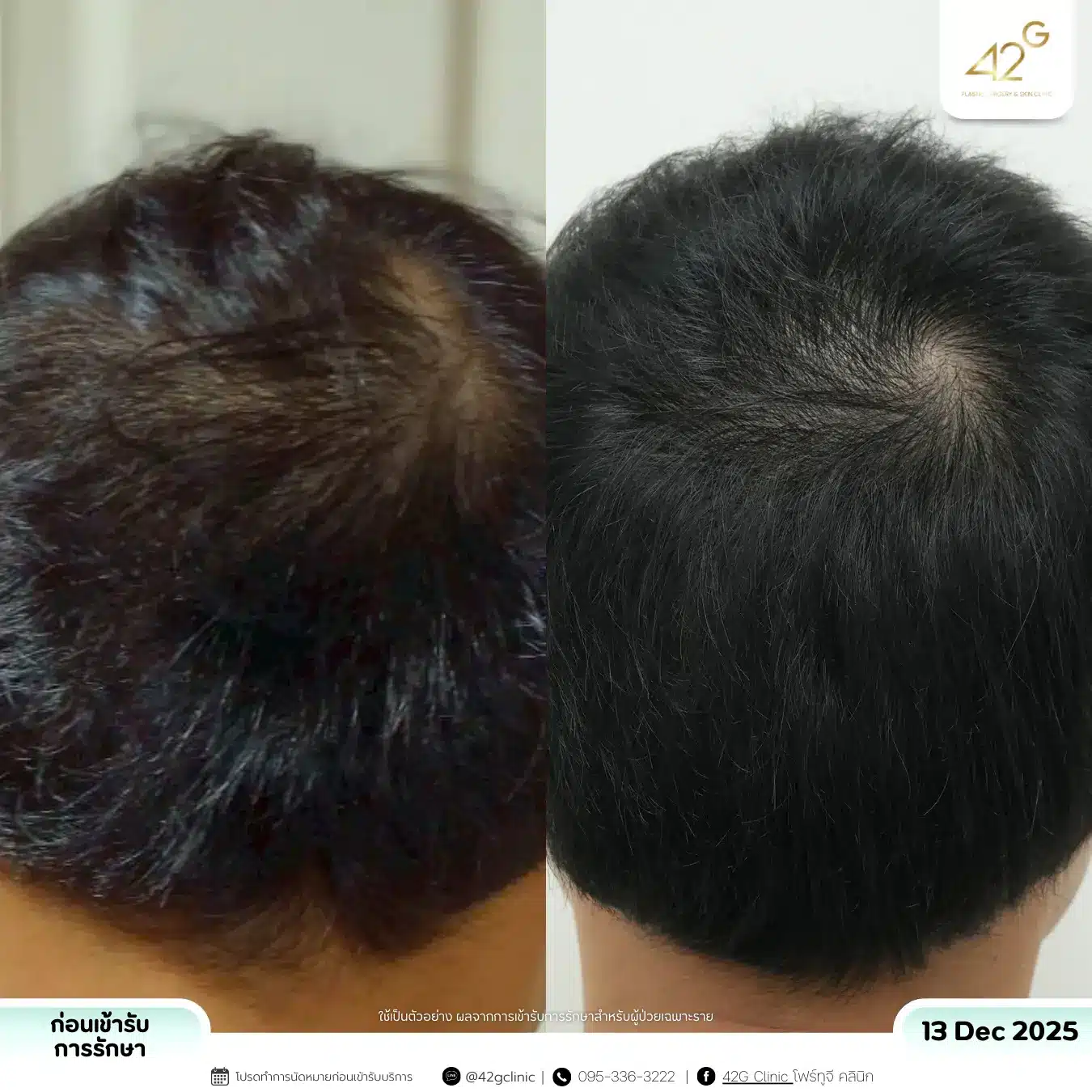 รีวิวPRP (4)