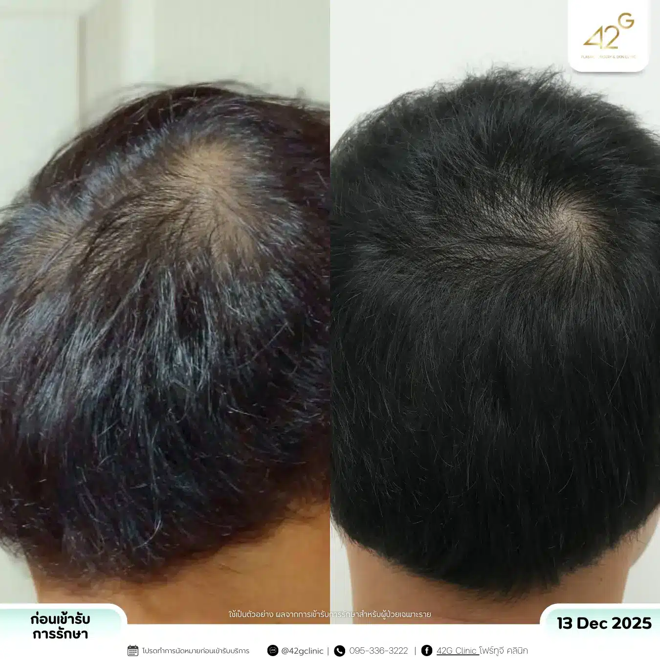 รีวิวPRP (5)