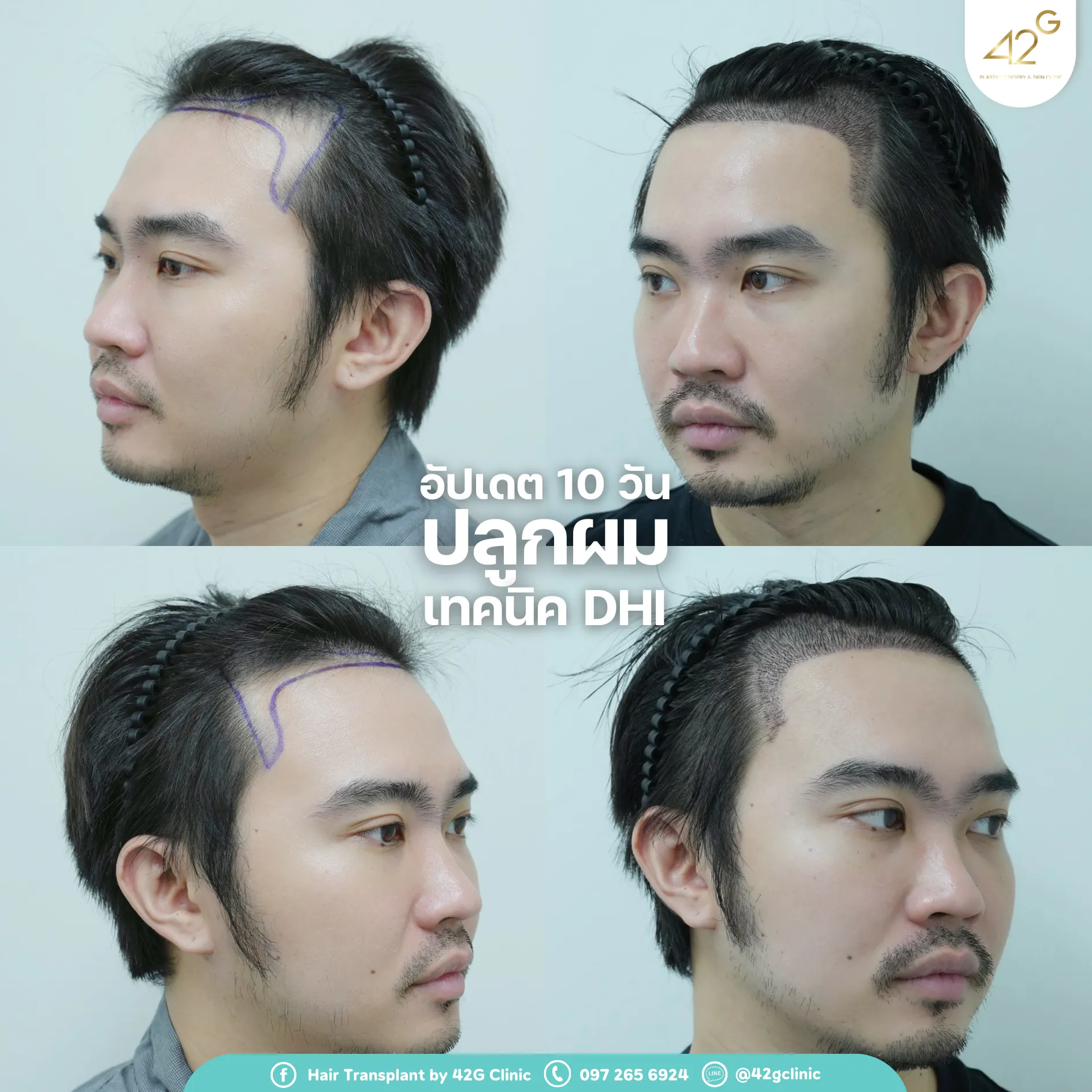 รีวิวปลูกผม42G 1
