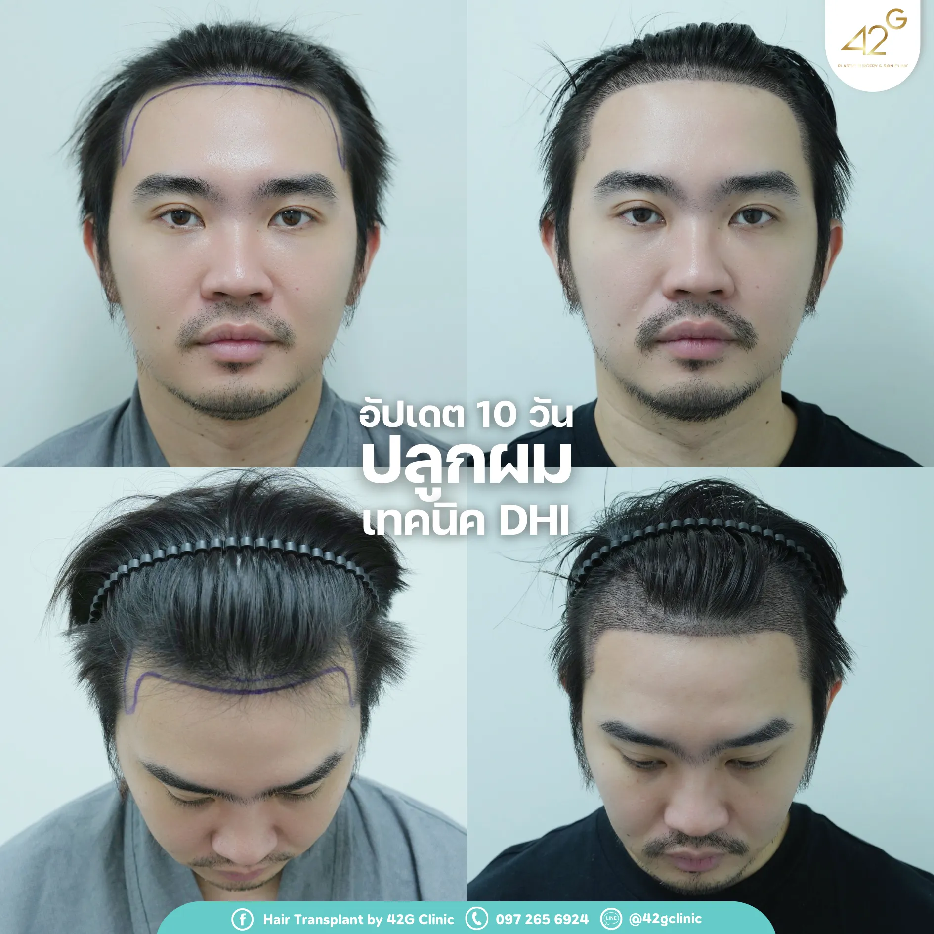 รีวิวปลูกผม42G 2