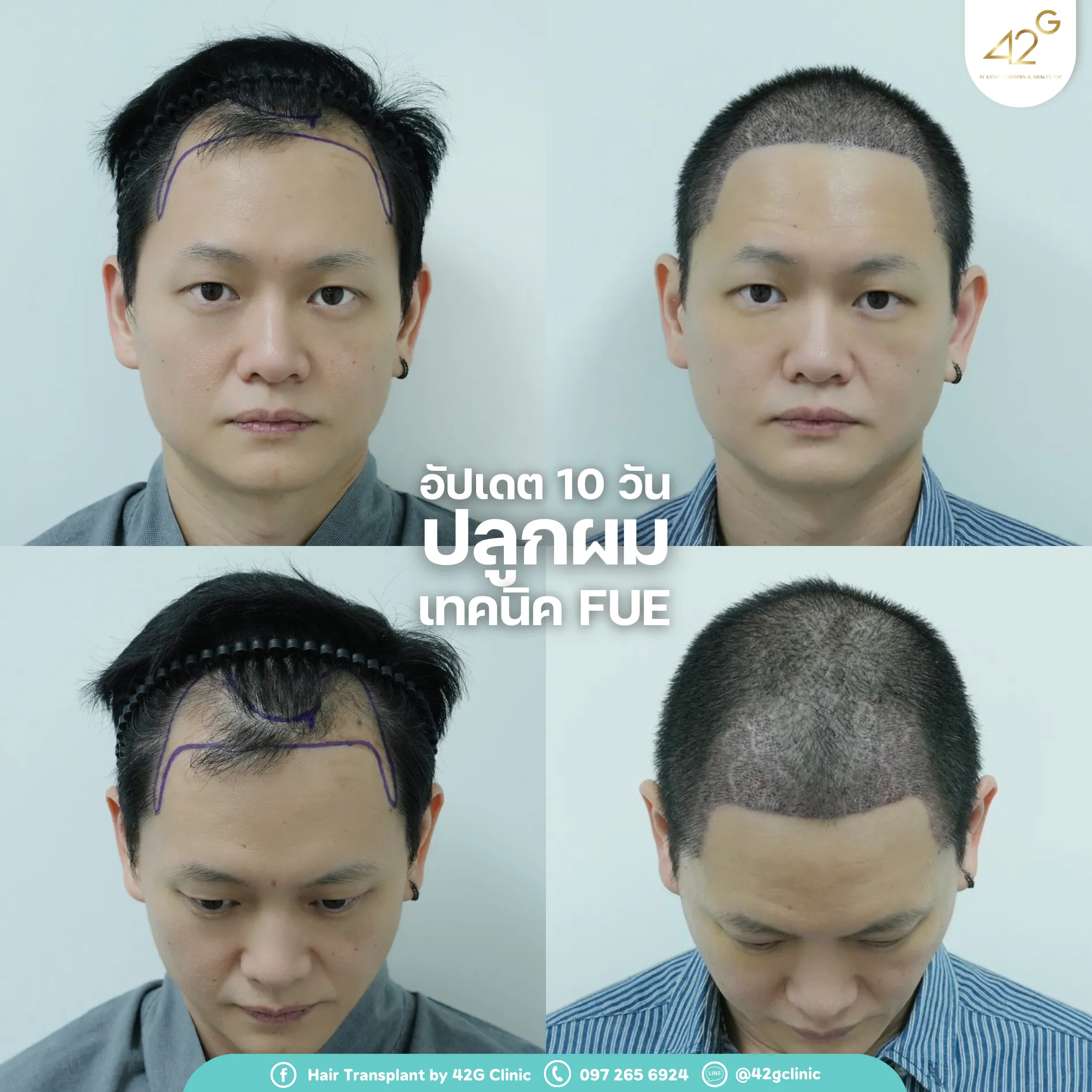 รีวิวปลูกผม42G 3