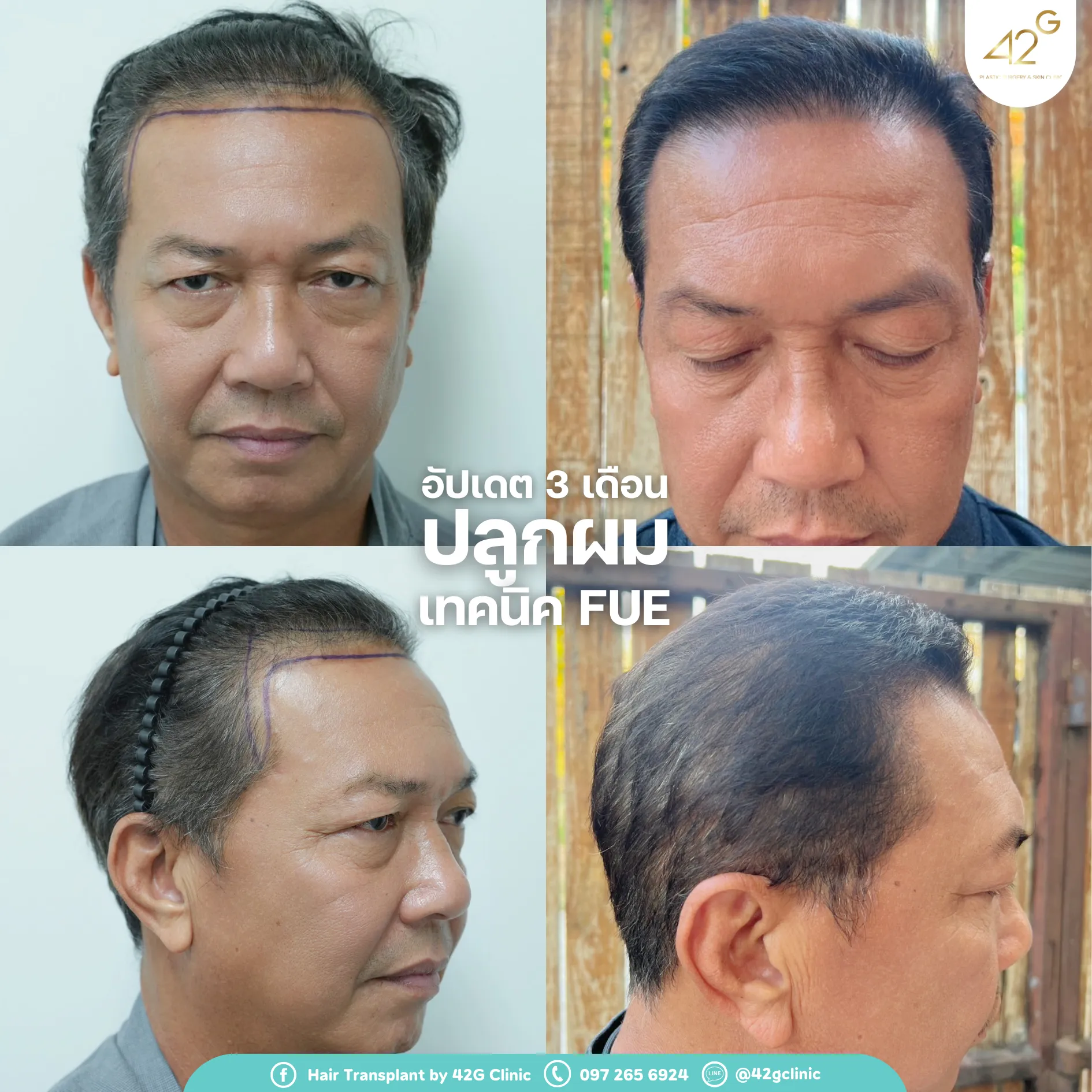 รีวิวปลูกผม42G 4