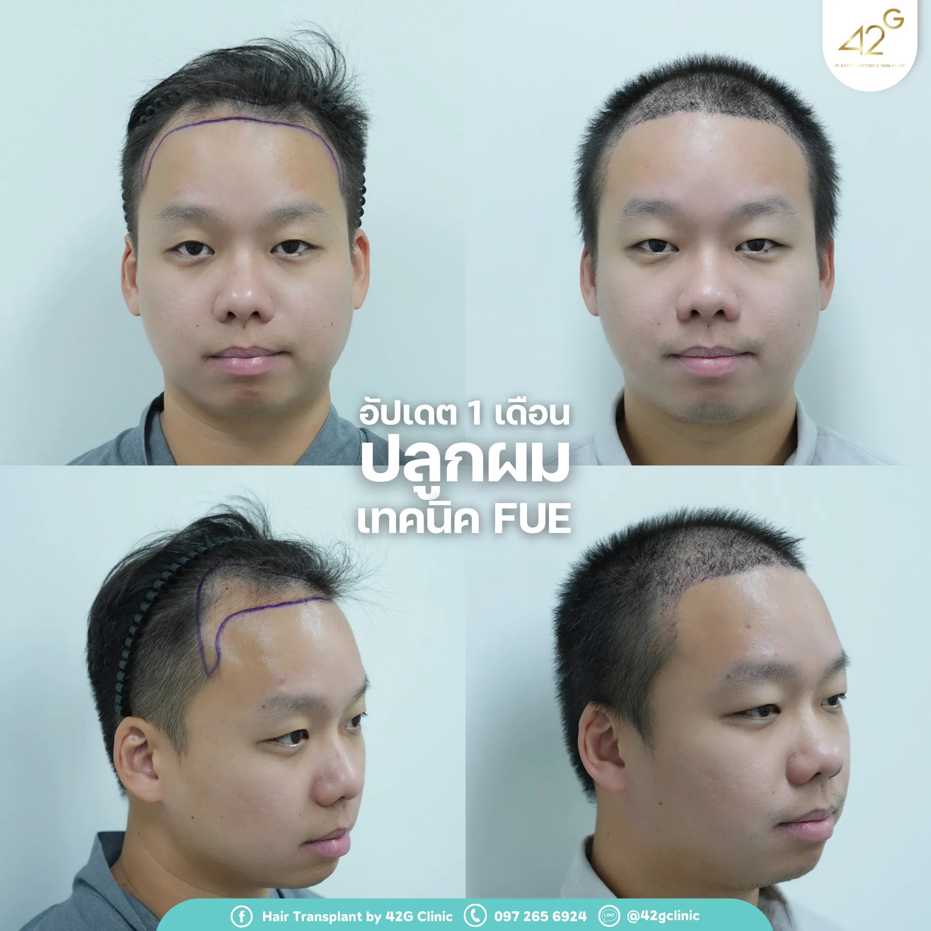 รีวิวปลูกผม42G 5