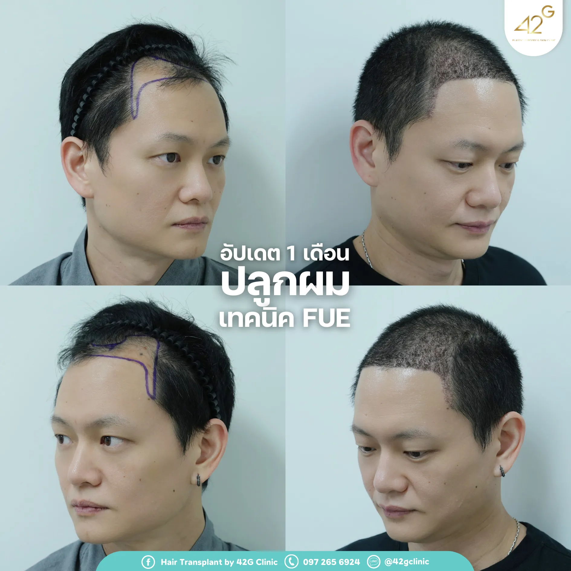รีวิวปลูกผม42G 6