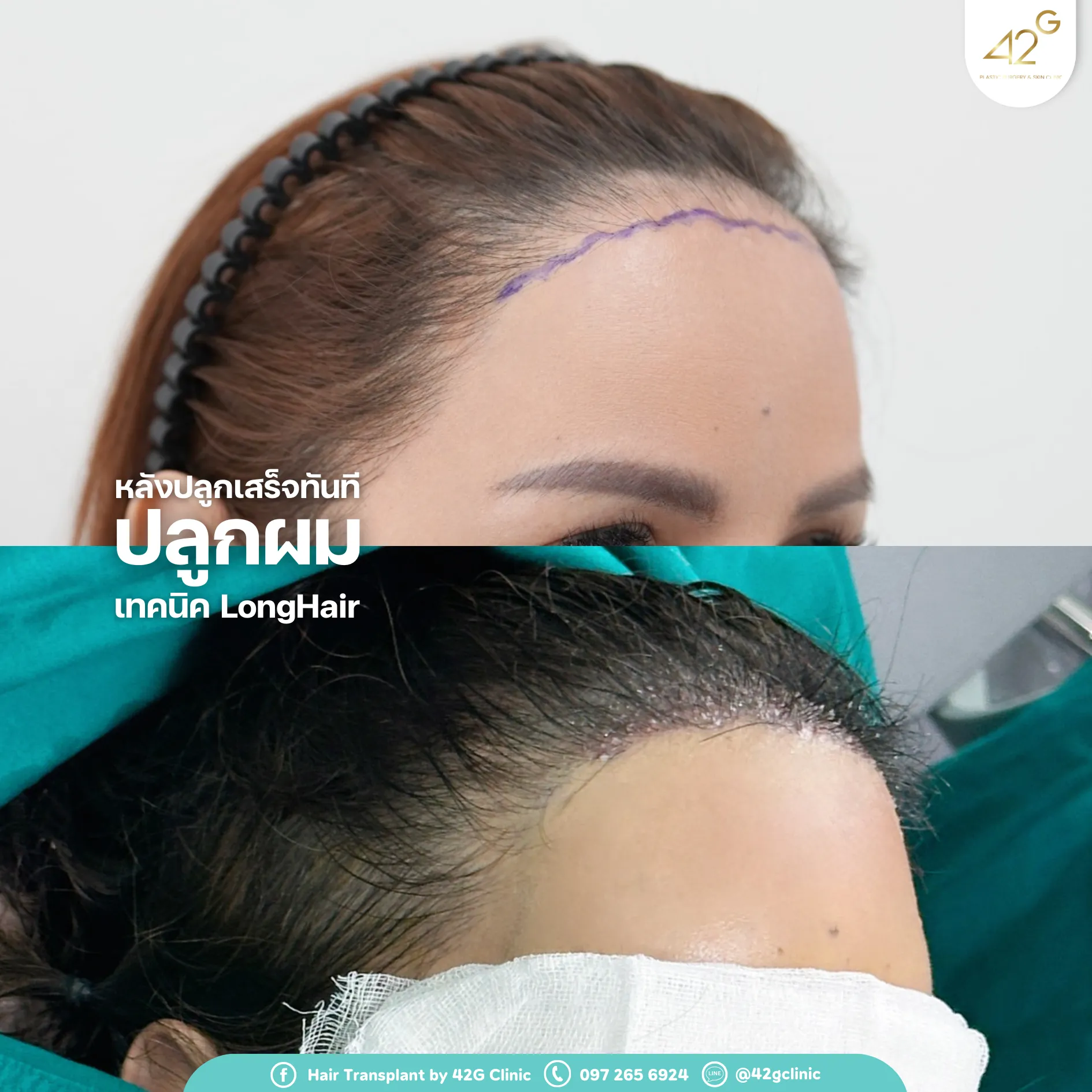 รีวิวปลูกผม42G 7