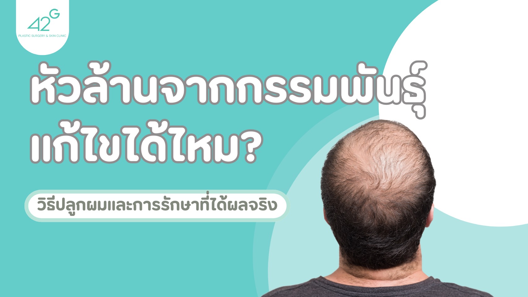หัวล้านจากกรรมพันธุ์