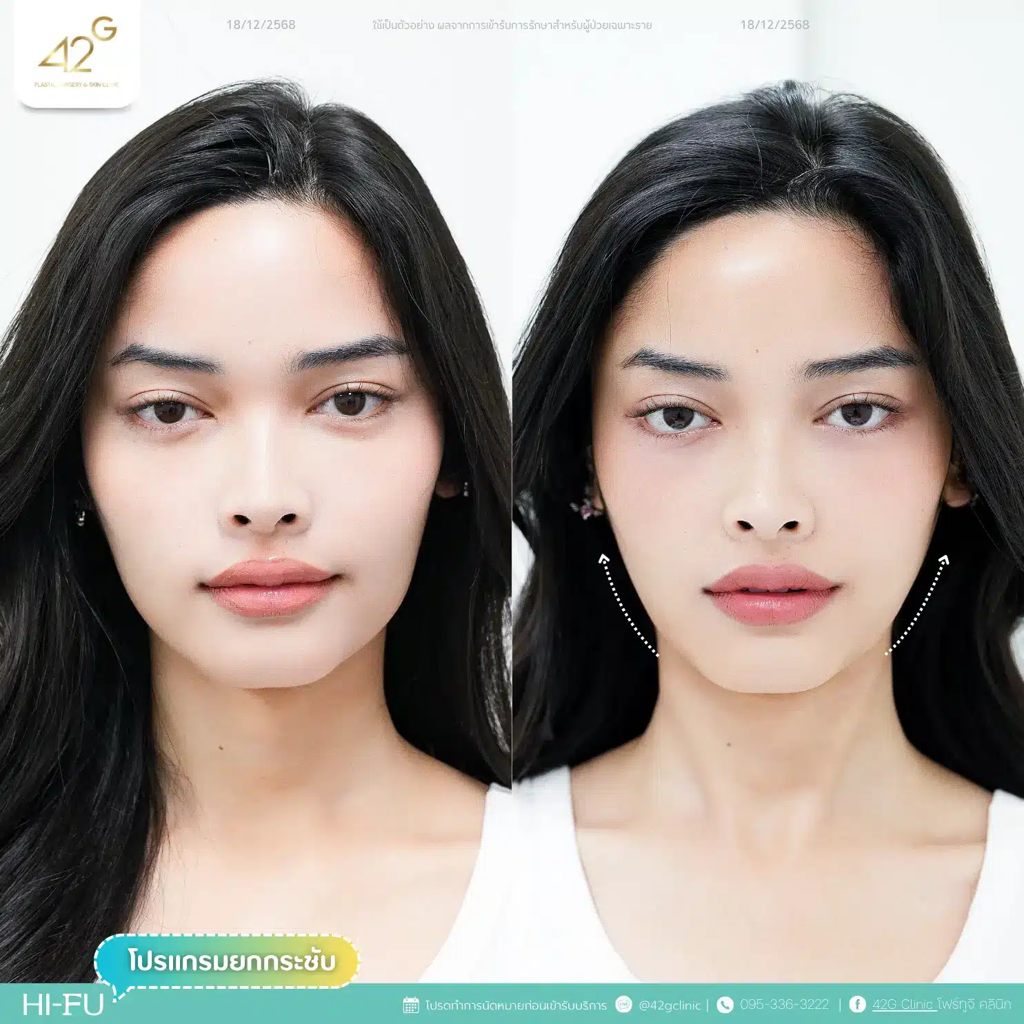 โปรแกรมยกกระชับ Ultra V-max (11)