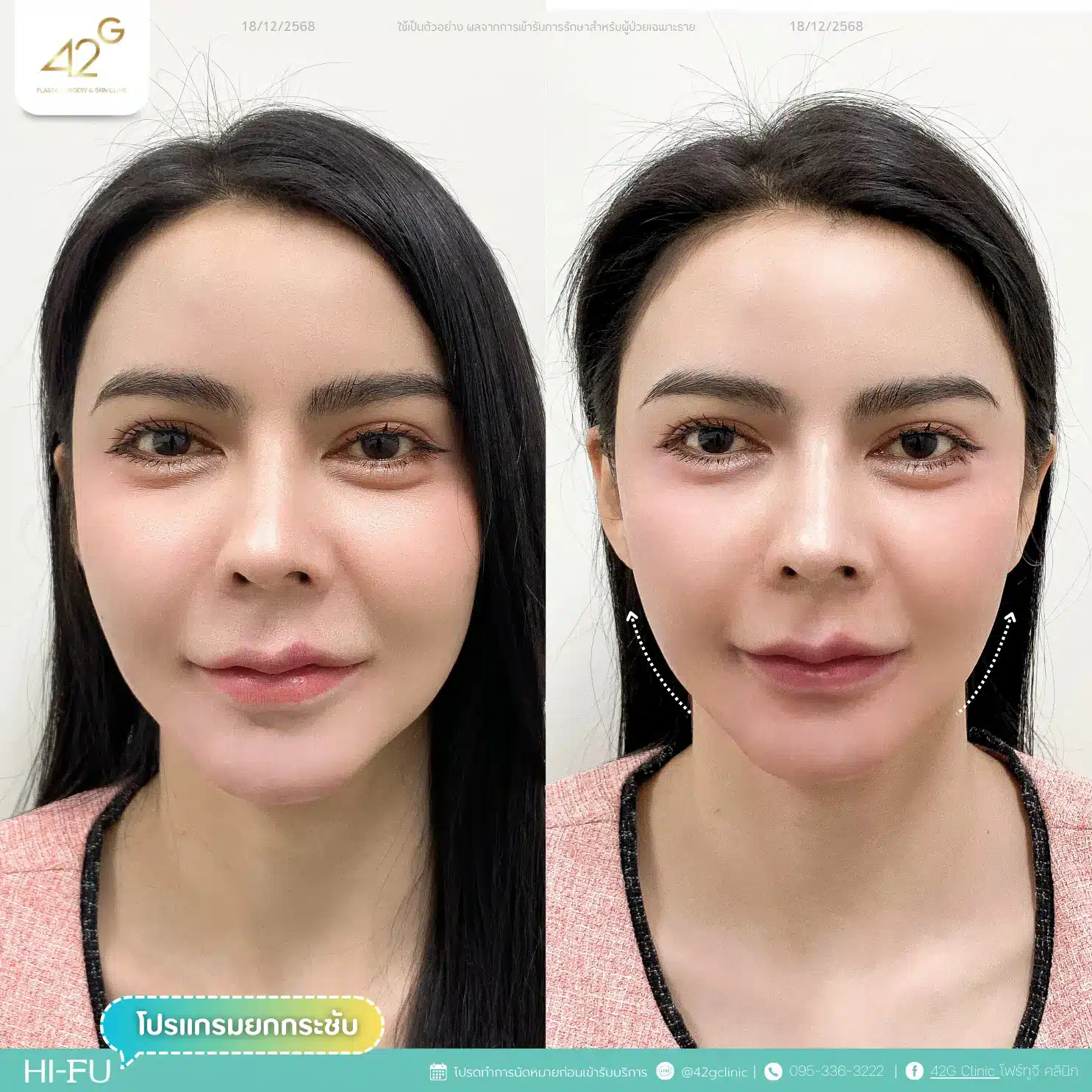 โปรแกรมยกกระชับ Ultra V-max (12)