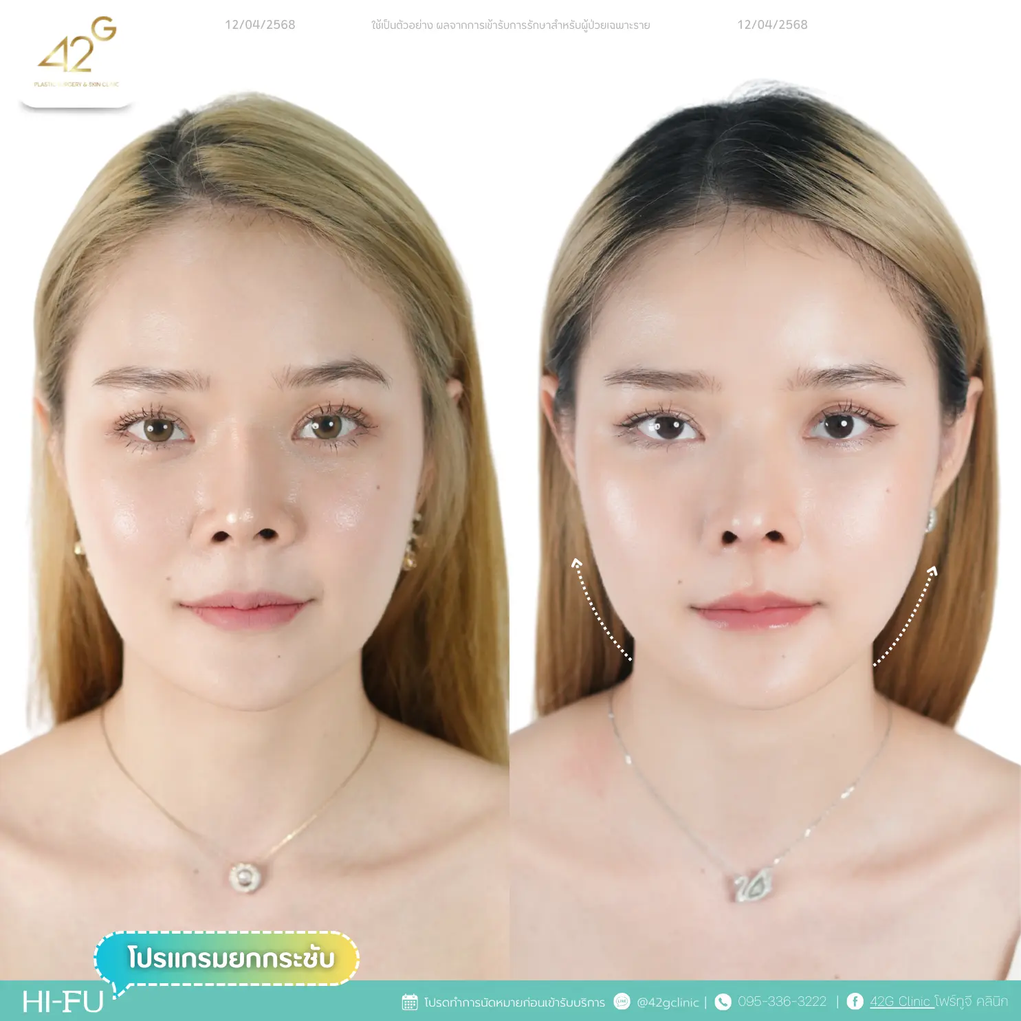 โปรแกรมยกกระชับ Ultra V-max (13)