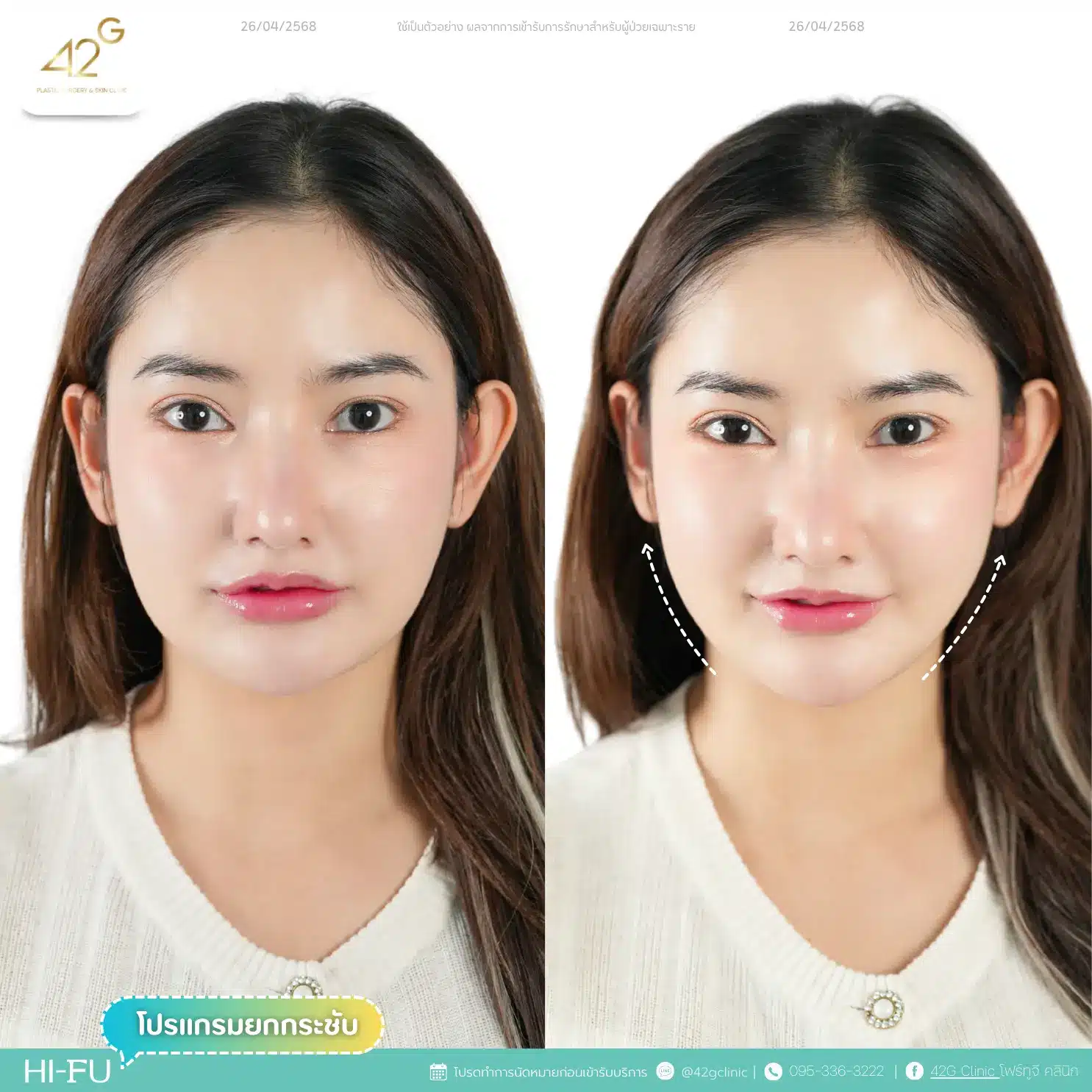 โปรแกรมยกกระชับ Ultra V-max (14)