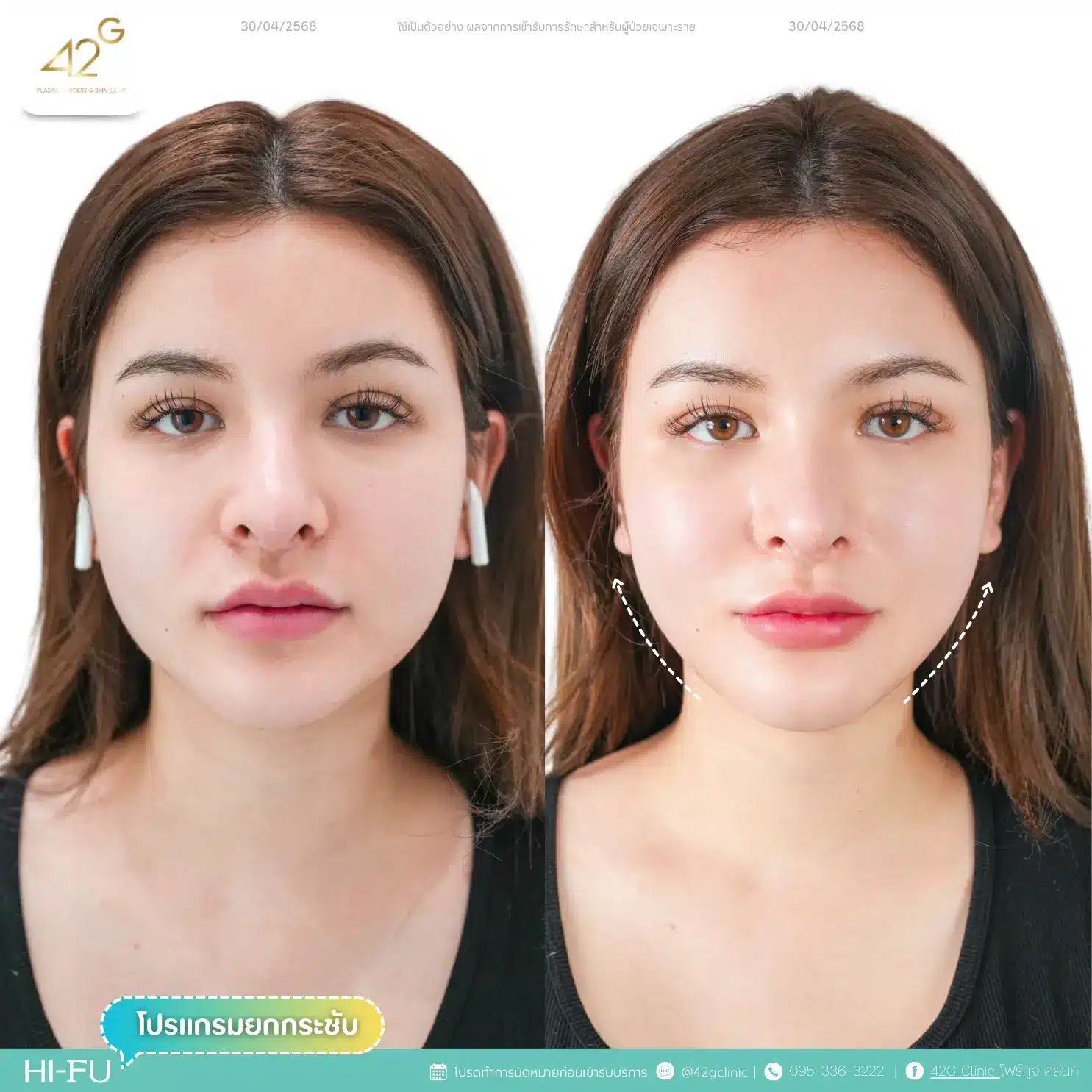 โปรแกรมยกกระชับ Ultra V-max (15)