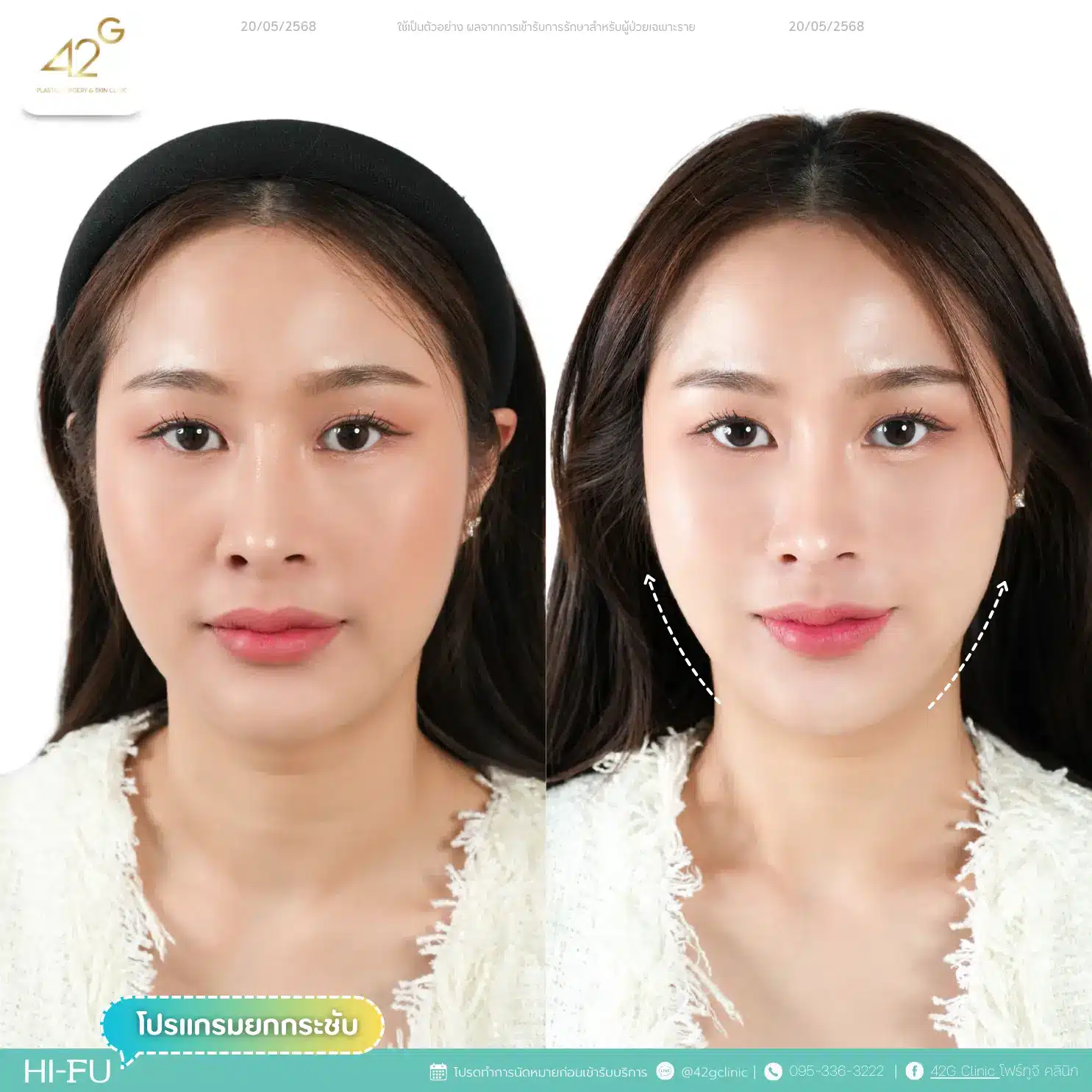 โปรแกรมยกกระชับ Ultra V-max (16)