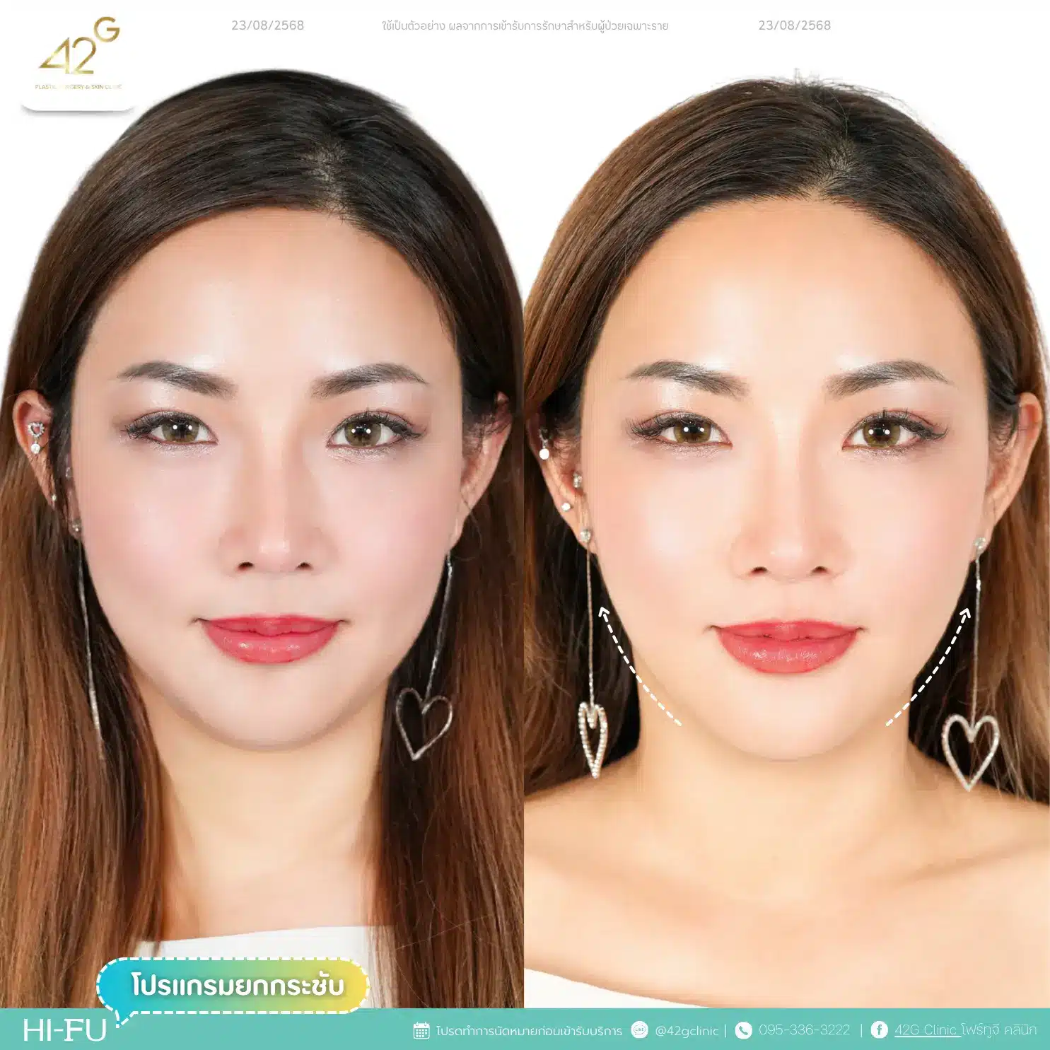 โปรแกรมยกกระชับ Ultra V-max (17)