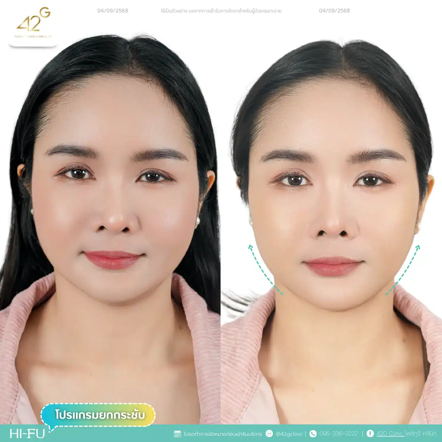 โปรแกรมยกกระชับ Ultra V-max (18)